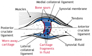 finger osteoarthritis JF