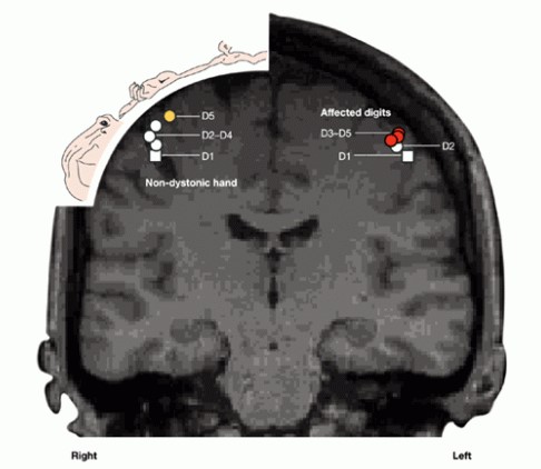 Focal dystonia brain scan